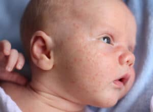 newborn skin reacts so easily